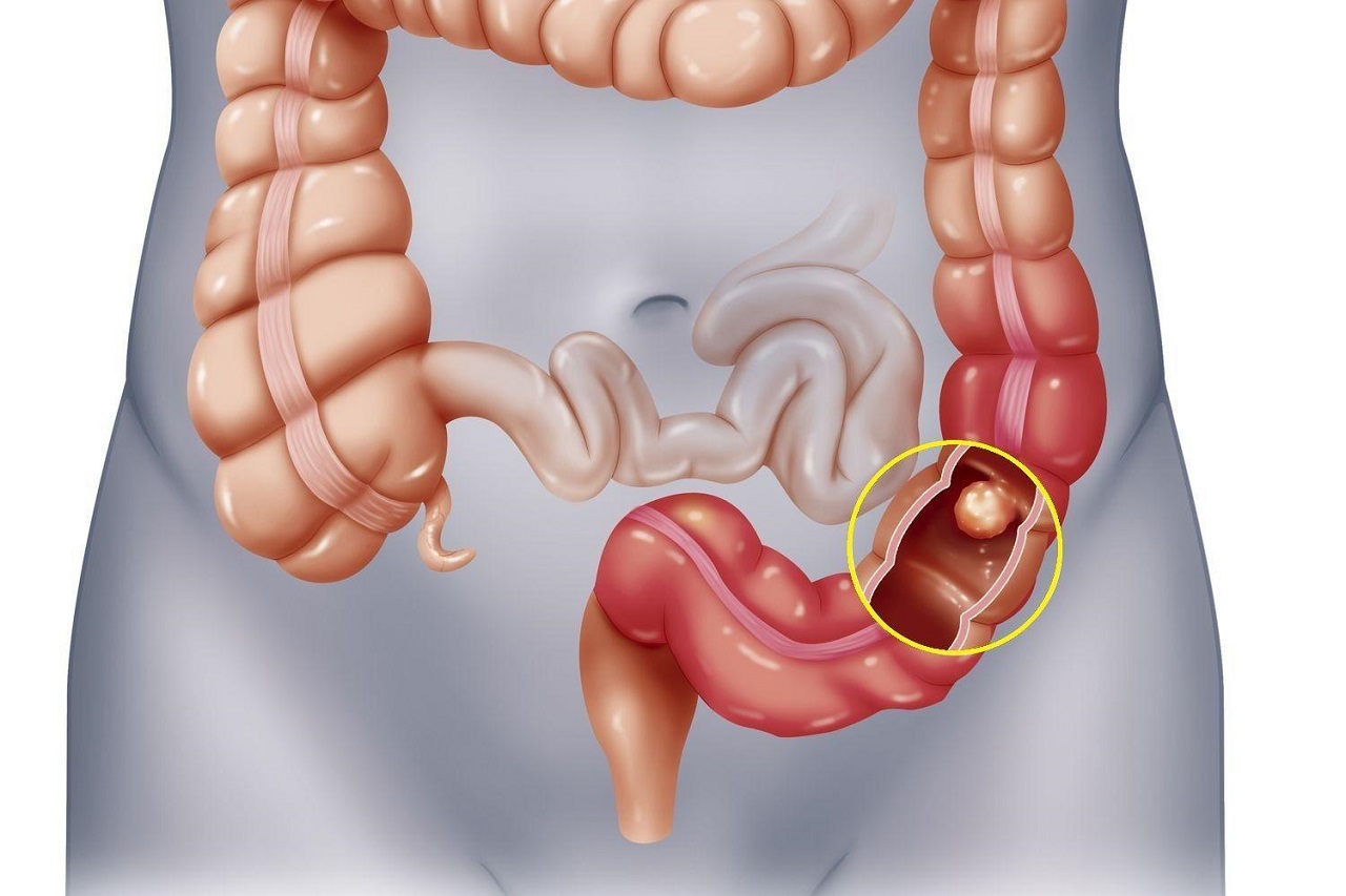 Tìm hiểu chung về bệnh đau ruột già 