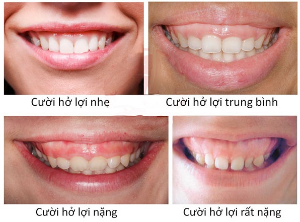 Tìm hiểu điều trị cười hở lợi giá bao nhiêu và cách chăm sóc