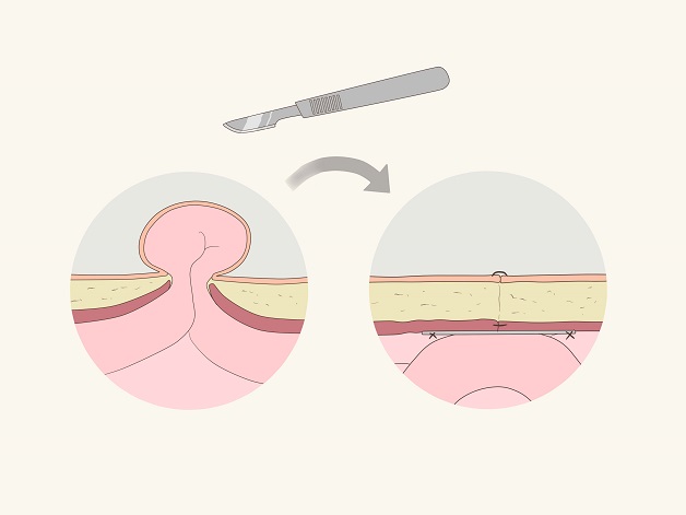 Tìm hiểu điều trị thoát vị bẹn như thế nào và cách phòng tránh