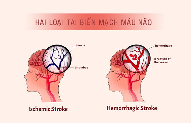 Tìm hiểu đột quỵ não qua các câu hỏi