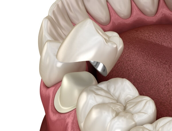 Tìm hiểu giải pháp bọc răng sứ quý kim phục hình thẩm mỹ