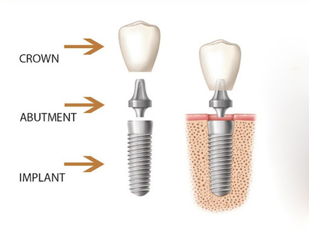 Tìm hiểu implant và 7 ưu điểm của cấy ghép implant