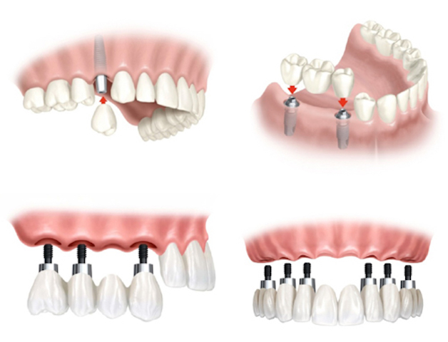 Tìm hiểu implant và 7 ưu điểm của cấy ghép implant