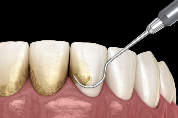 Tìm hiểu: Lấy cao răng nhiều có tốt không?