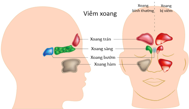 Tìm hiểu ngay: Viêm xoang sàng có điều trị được không?