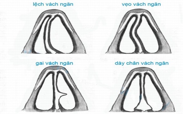 Tìm hiểu ngay: Viêm xoang sàng có điều trị được không?