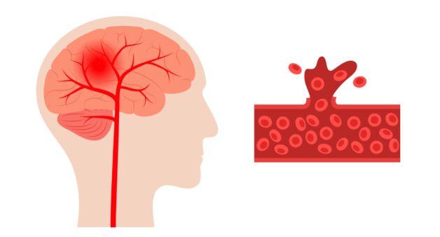 Tìm hiểu nguyên do đột quỵ xảy ra khi tắm đêm