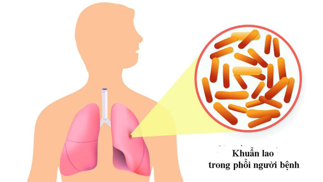 Tìm hiểu nguyên nhân gây bệnh lao phổi cần lưu ý phòng tránh