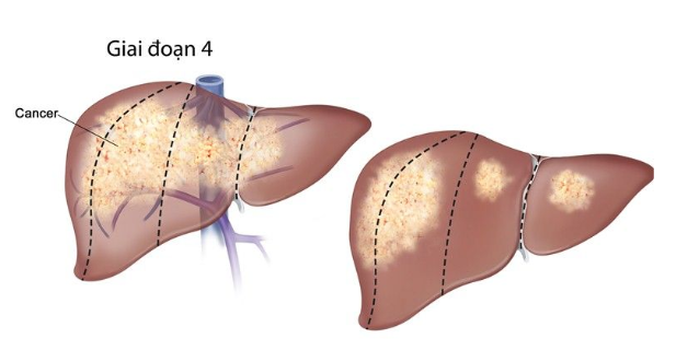 Tìm hiểu nguyên nhân ung thư gan khó phát hiện