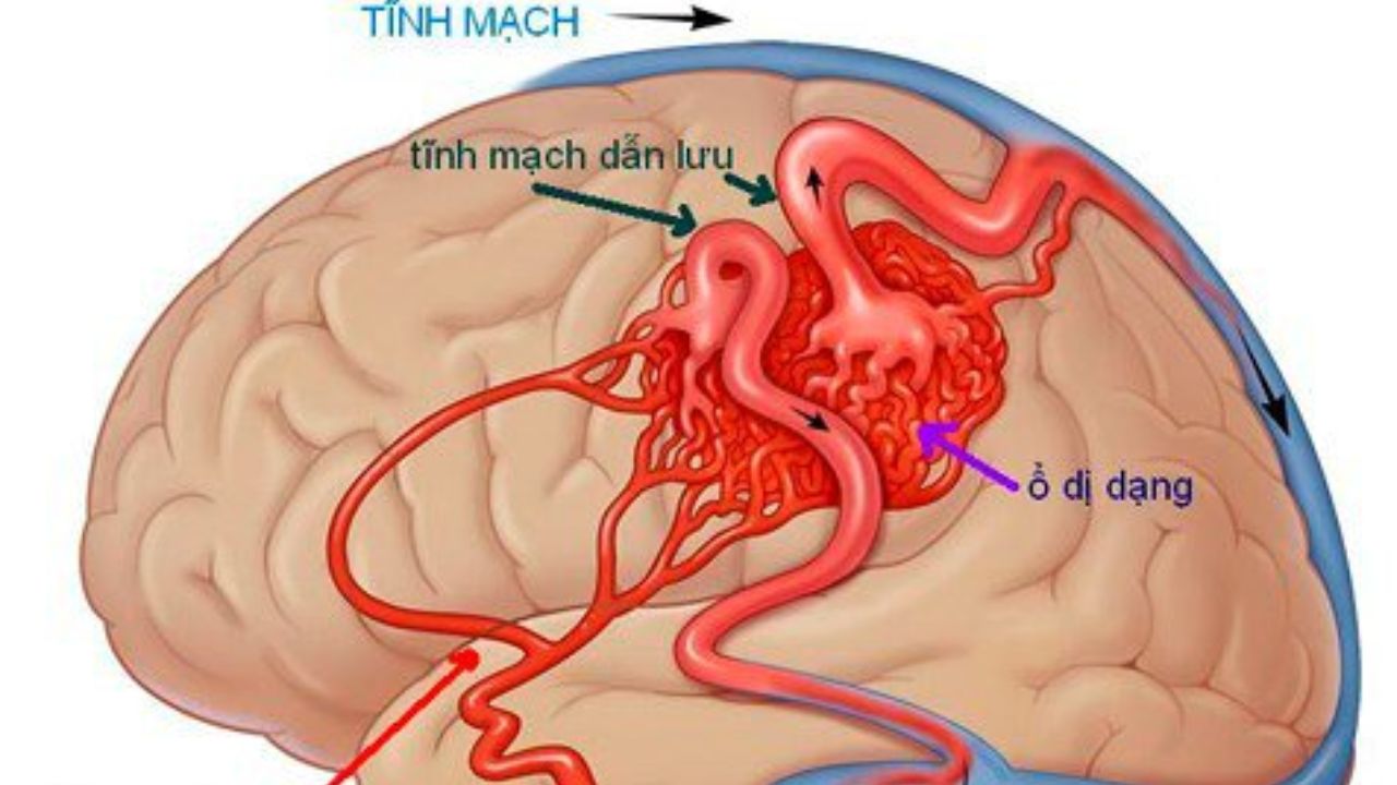 Tìm hiểu nguyên nhân và dấu hiệu dị dạng mạch não