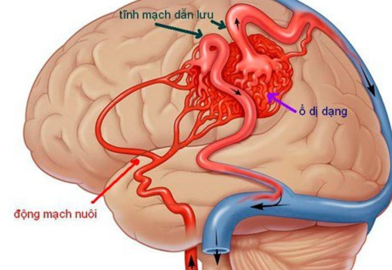 Tìm hiểu nguyên nhân và dấu hiệu dị dạng mạch não