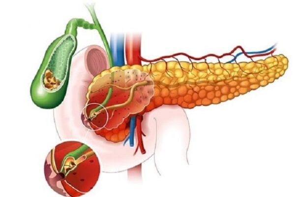 Tìm hiểu nguyên nhân viêm tụy cấp