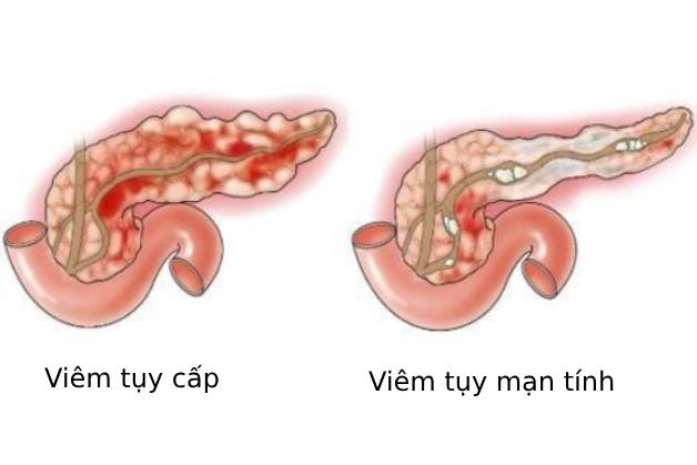 Tìm hiểu nguyên nhân viêm tụy ở người lớn và cách phòng bệnh