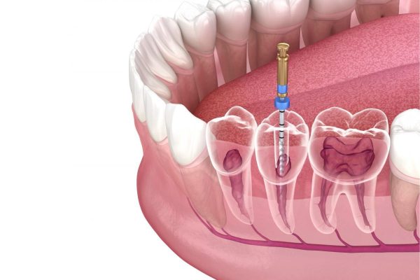 Tìm hiểu nguyên tắc điều trị tủy răng