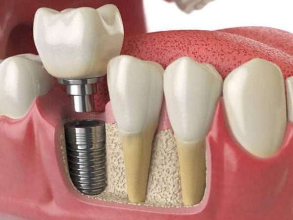 Tìm hiểu những thông tin về quá trình cấy ghép Implant