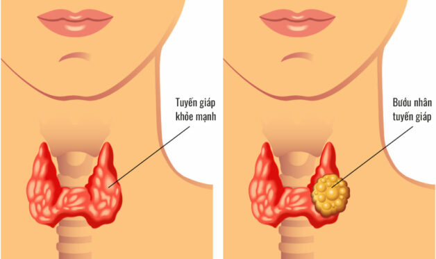 Tìm hiểu phác đồ điều trị viêm tuyến giáp