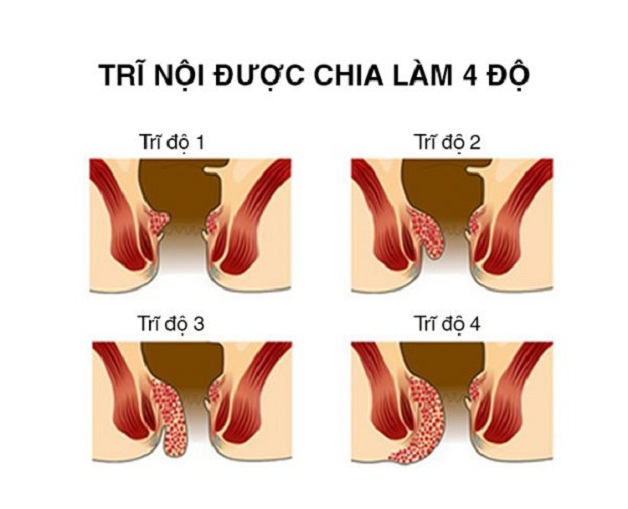 Tìm hiểu: Phẫu thuật cắt trĩ giá bao nhiêu?