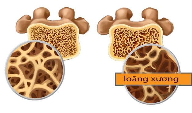 Tìm hiểu phương pháp điều trị loãng xương hiệu quả