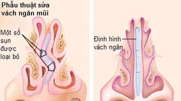 Tìm hiểu phương pháp phẫu thuật chỉnh hình vách ngăn mũi qua nội soi