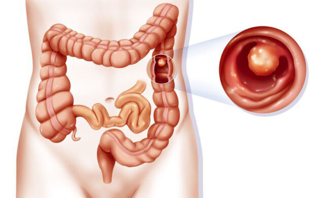 Tìm hiểu polyp có phải là u không?