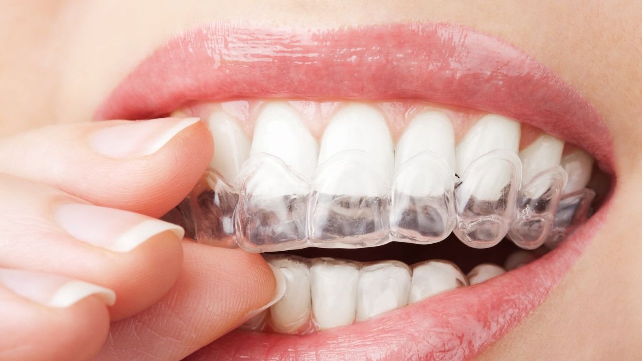 Tìm hiểu quá trình thực hiện niềng răng Invisalign