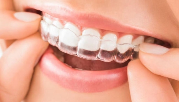 Tìm hiểu quá trình thực hiện niềng răng Invisalign