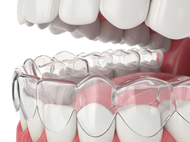 Tìm hiểu quá trình thực hiện niềng răng Invisalign