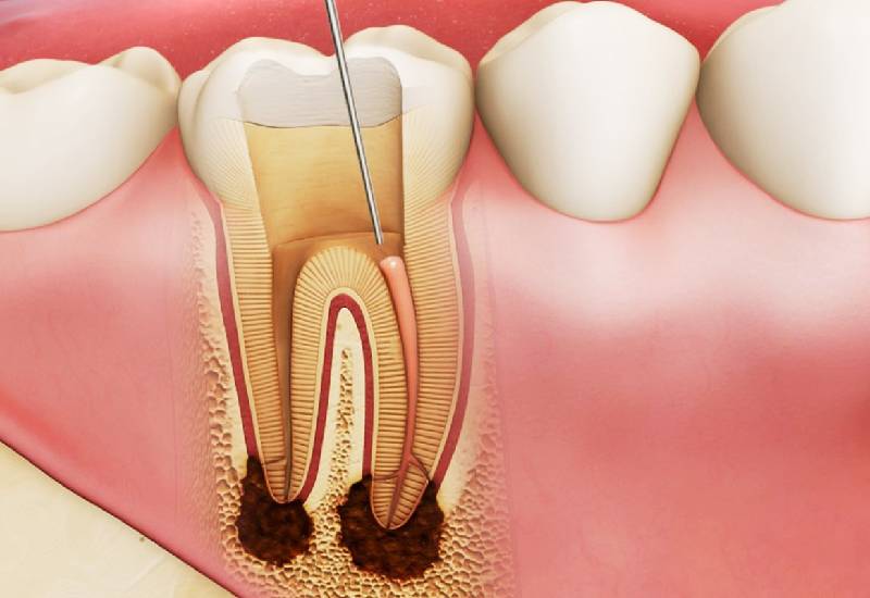 Tìm hiểu quy trình điều trị tủy răng của Bộ Y tế