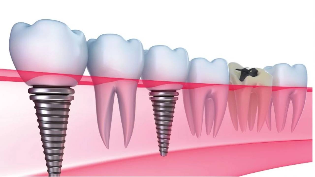 Tìm hiểu quy trình trồng răng Implant mới nhất