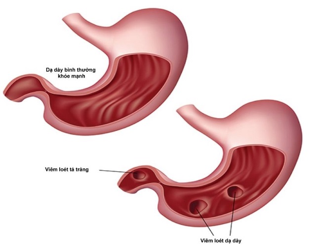 Tìm hiểu sinh lý bệnh loét dạ dày tá tràng