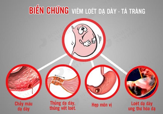 Tìm hiểu sinh lý bệnh loét dạ dày tá tràng