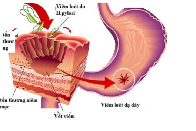 Tìm hiểu sinh lý bệnh loét dạ dày tá tràng