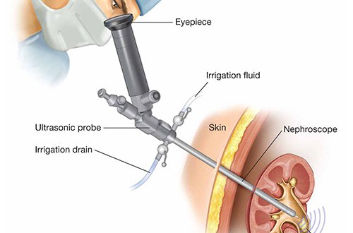 Tìm hiểu tán sỏi thận là gì và có hiệu quả không?