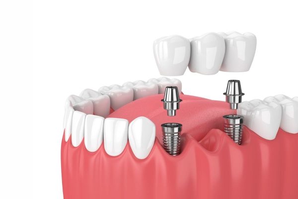 Tìm hiểu thời gian cấy ghép implant mất bao lâu?