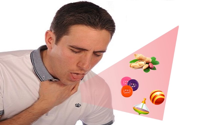 Tìm hiểu tổng quan về phương pháp sơ cứu hóc dị vật Heimlich