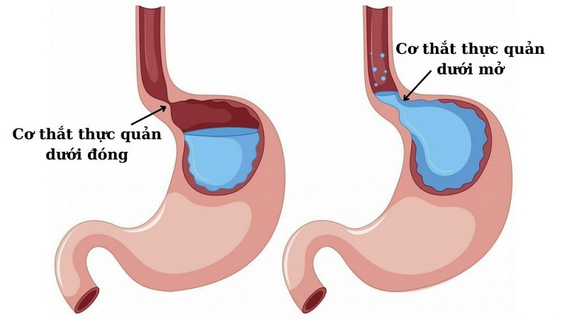 Tìm hiểu triệu chứng bị trào ngược dạ dày và cách chẩn đoán