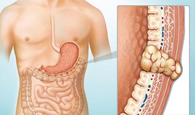 Tìm hiểu u dưới niêm mạc dạ dày là gì?