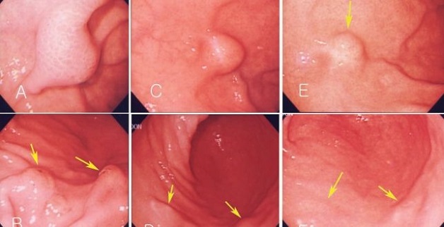 Tìm hiểu u dưới niêm mạc dạ dày là gì?