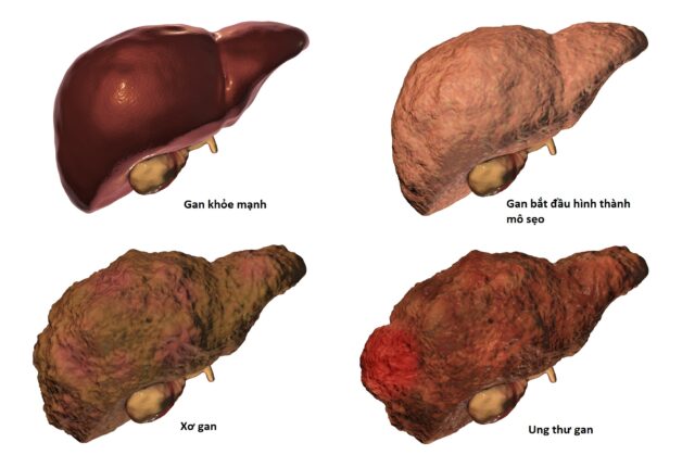 Tìm hiểu ung thư gan là gì và cách phòng tránh