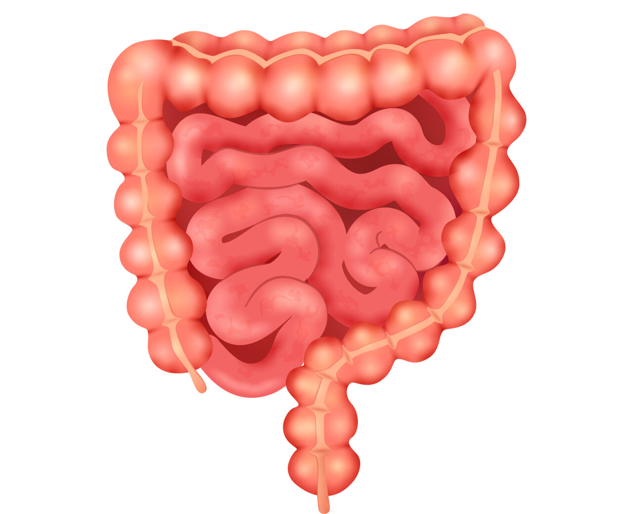 Tìm hiểu về bệnh crohn ruột