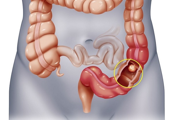 Tìm hiểu về bệnh crohn ruột