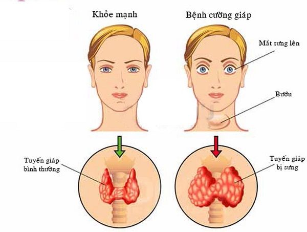 Tìm hiểu về bệnh cường giáp: Triệu chứng và cách điều trị