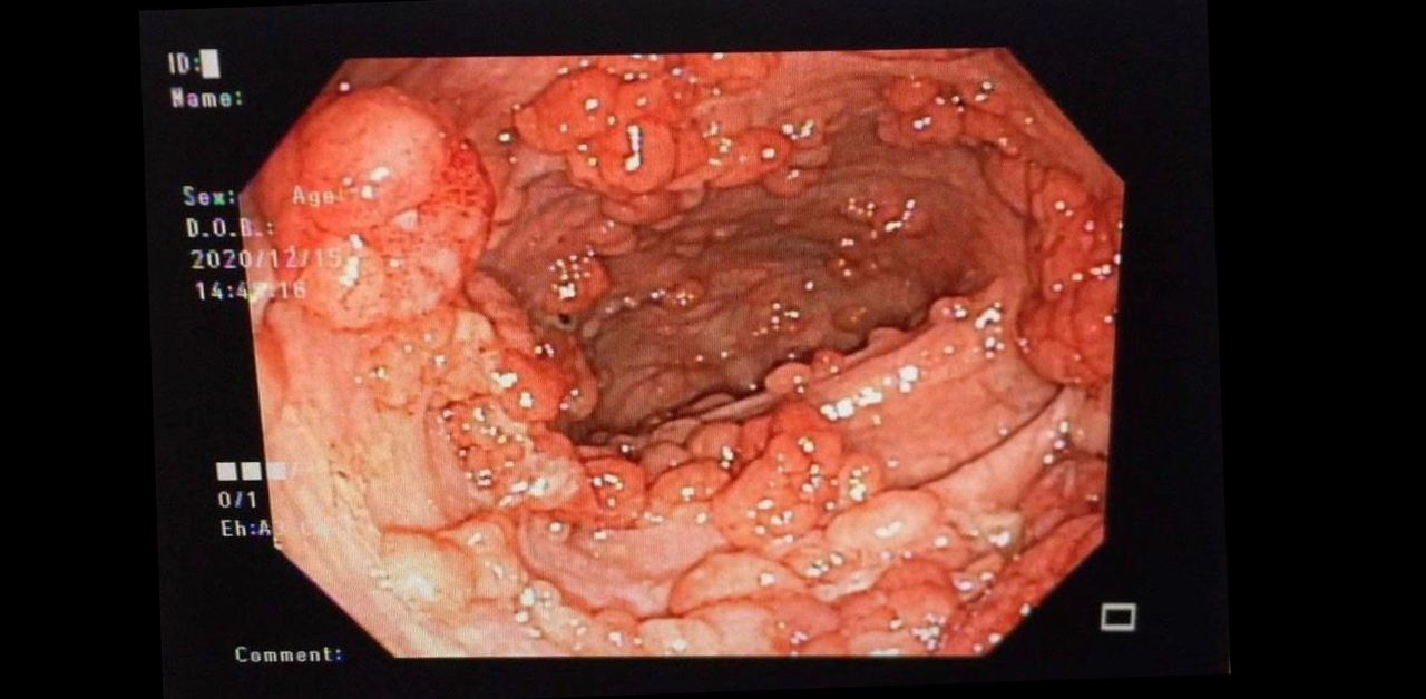 Tìm hiểu về bệnh đa polyp đại tràng gia đình 