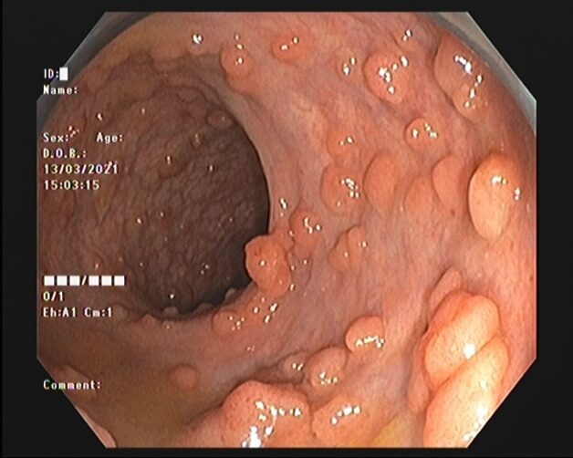 Tìm hiểu về bệnh đa polyp đại tràng gia đình 