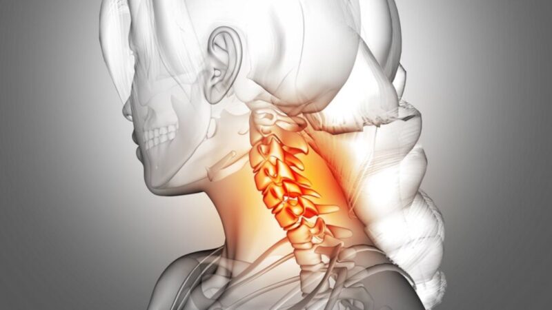 Tìm hiểu về bệnh hẹp lỗ liên hợp đốt sống cổ