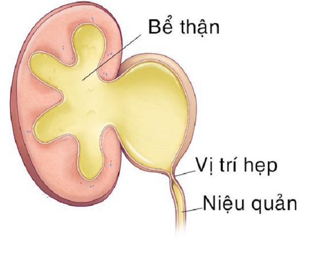 Tìm hiểu về bệnh hẹp niệu quản và cách điều trị hẹp niệu quản 