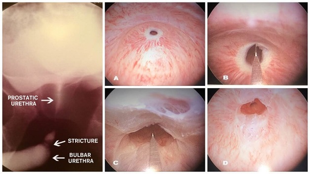 Tìm hiểu về bệnh hẹp niệu quản và cách điều trị hẹp niệu quản 