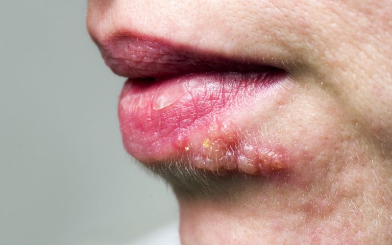 Tìm hiểu về bệnh Herpes lây qua đường tình dục