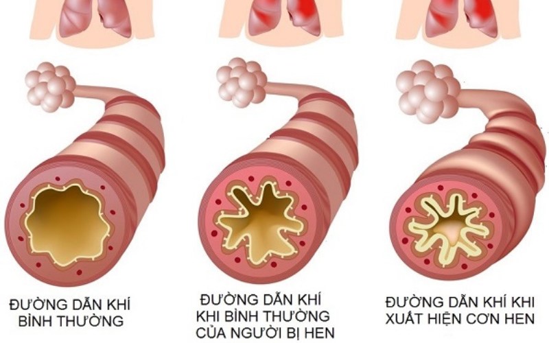 Tìm hiểu về bệnh lý hen phế quản cấp và cách phòng ngừa