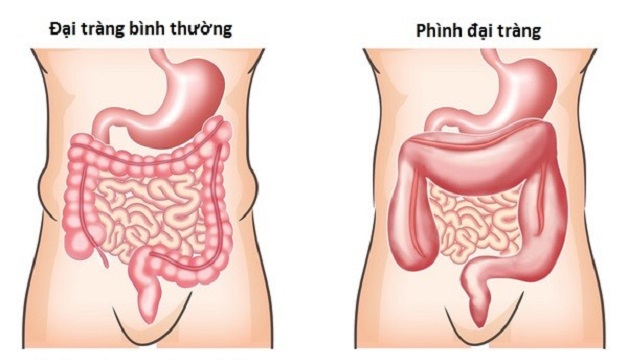 Tìm hiểu về bệnh phình đại tràng